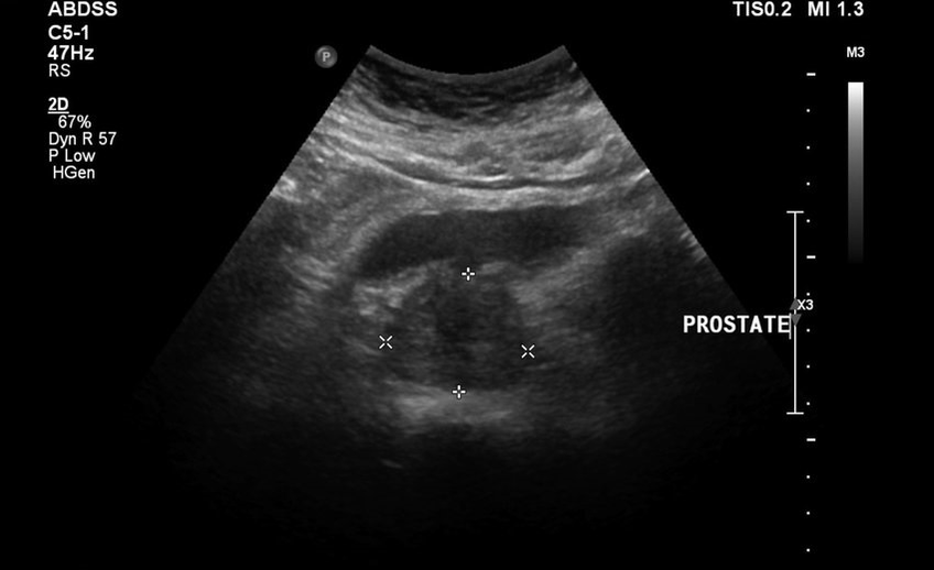 Postatitis for ultrasound before taking Urosaf