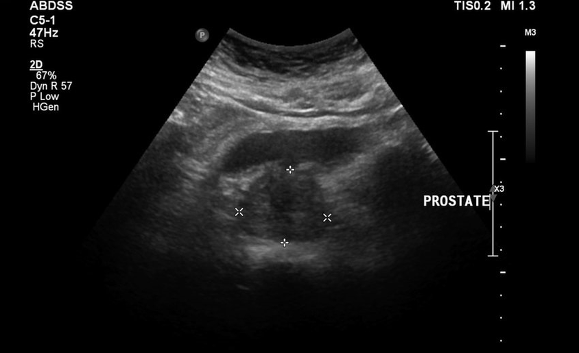 Ultrasound prostatitis before taking zxcvbnmqwert